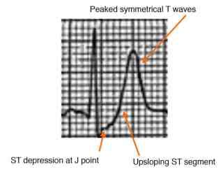 STEMI Equivalents: De Winter’s T Waves – SCOPE