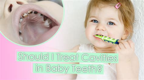 Should You Treat Cavities In Baby Teeth? » Top Cosmetic Dentist In San ...