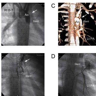 Total occlusion of left modified Blalock–Taussig (B–T) shunt in a ...