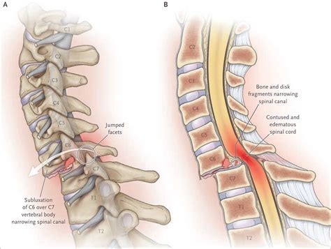 Spinal Cord Compression | NEJM Resident 360