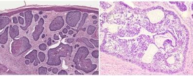 Histology of nodular BCC. Source: Takita (2019). | Download Scientific ...