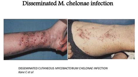 Atypical mycobacterial infections in dermatology