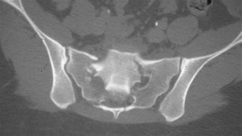 Sacral Fractures - Trauma - Orthobullets