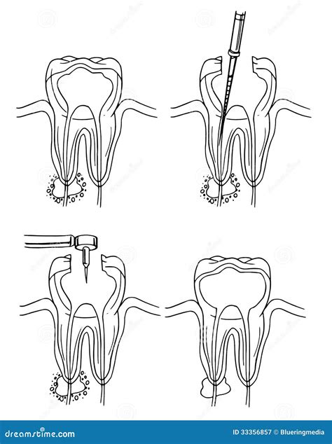 Root canal procedure stock illustration. Illustration of black - 33356857