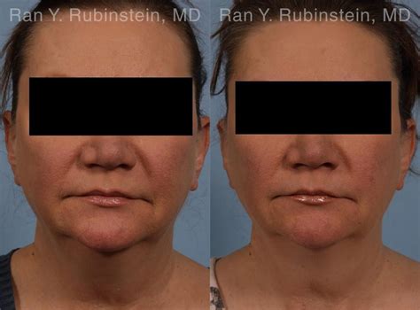 Coolsculpting Neck in Newburgh, NY | Dr. Ran Y. Rubinstein