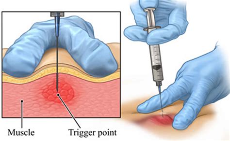 Trigger point injections, trigger point injection technique & side effects