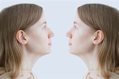 Surgical Solutions for a Hooked Nose | Becker Rhinoplasty Center