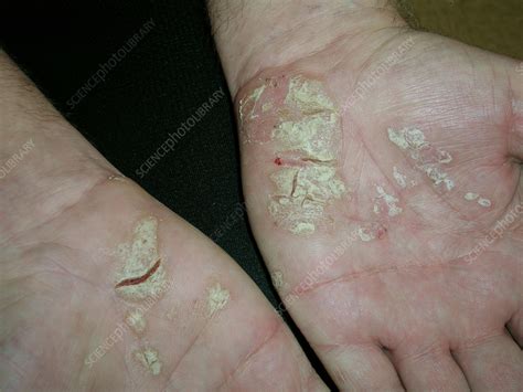 Palmar plantar psoriasis - Stock Image - C056/4946 - Science Photo Library