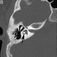 Figure .. Lateral semicircular canal complex. (A) Axial temporal bone... | Download Scientific ...