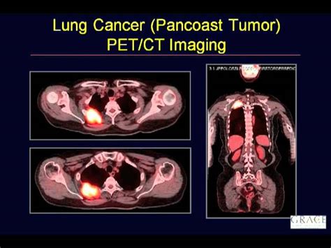 Pet Scan Images Lung Cancer