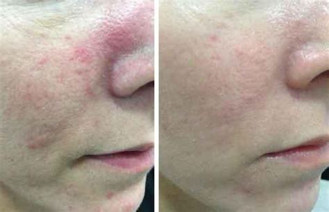 IPL for Rosacea: Everything You Should Know - VIDA Wellness and Beauty