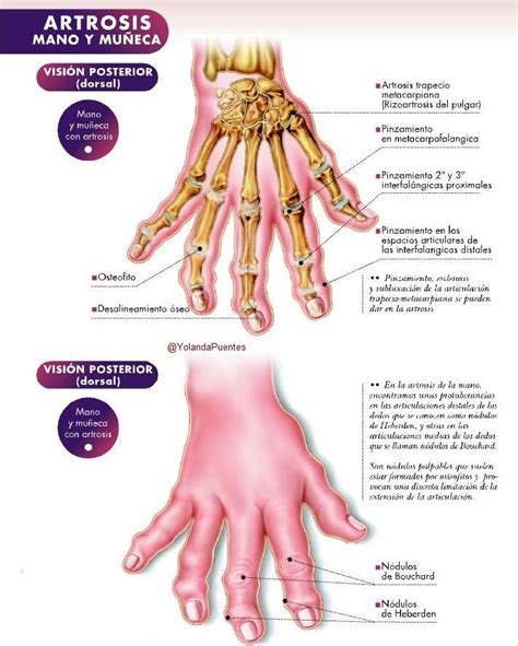 Artrosis de la mano, signos. Anatomía. Traumatología | Med student, Ekg