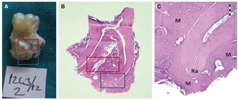 Familial gigantiform cementoma with Ehlers - Danlos syndrome: A report of 2 cases