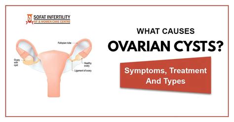 What is Ovarian Cyst? Causes, Symptoms, Treatment, Types - Dr. Sumita Sofat Hospital