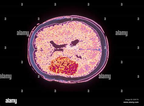 Encephalitis brain hi-res stock photography and images - Alamy