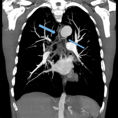 Radiology - Bronchiectasis