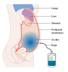 Ascites - Wikipedia