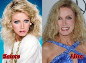 Donna Mills Plastic Surgery: Great Example or Epic Fail? - Plastic ...