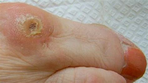 Foot corn : callus of dead skin , on dorsal surface of toes or fingers ...