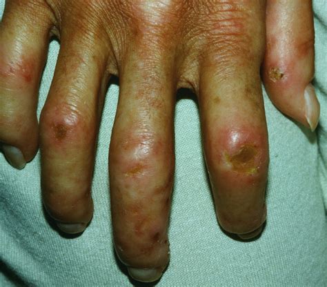 Scleroderma - Causes, Symptoms, Prognosis, Diagnosis, Treatment