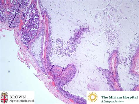 Mucocele