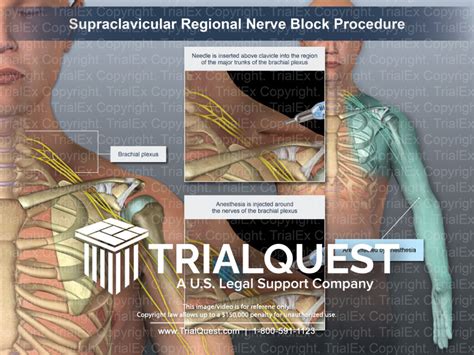 Supraclavicular Regional Nerve Block Procedure - TrialExhibits Inc.