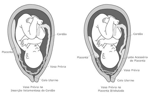 O que é Vasa Prévia? | Fetalmed Medicina Fetal Curitiba