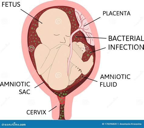 Chorioamnionitis or Intra-amniotic Infection IAI is an Inflammation of the Fetal Membranes ...