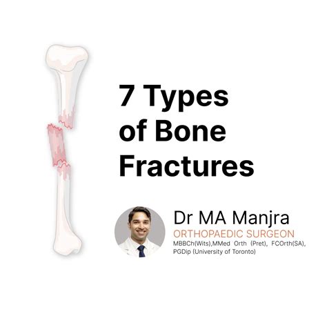 7 Types Of Bone Fractures - Orthopaedic Surgeon Durban