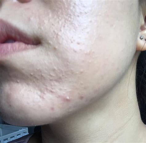 [ACNE] Fungal Acne Product Before and After 6 weeks : SkincareAddiction