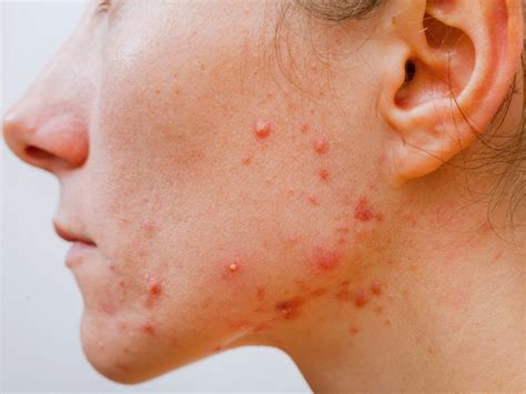 Serious Allergic Reactions Possible With Acne Products