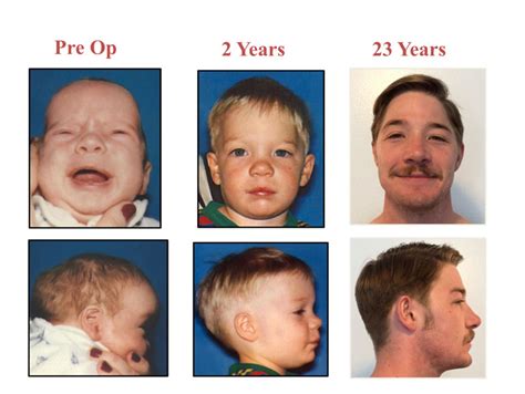 Craniosynostosis