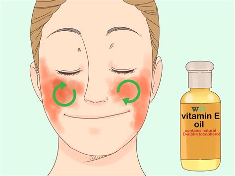 Vitamin D Eczema Cure