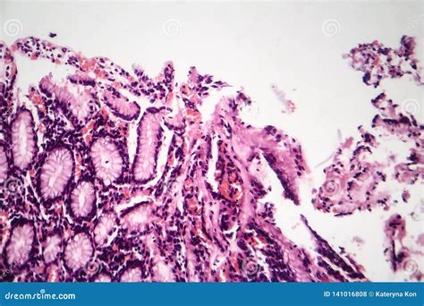 Chronic Atrophic Gastritis, Light Micrograph Stock Photo - Image of ...