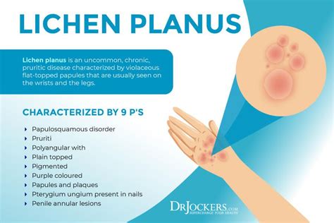 Lichen Planus: Symptoms, Causes & Support Strategies | Lichen planus, Lichen planus cure, Lichen