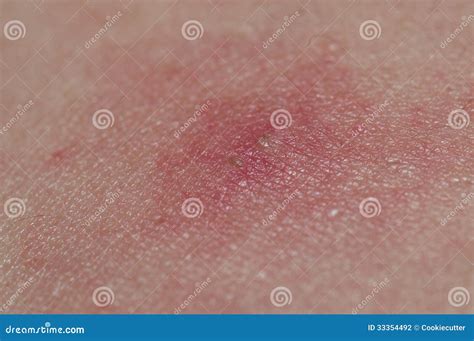 Allergic Skin Stock Photography - Image: 33354492