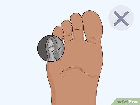 How to Buddy Tape an Injured Toe: 7 Steps (with Pictures)