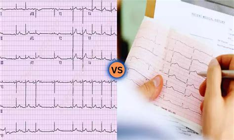 Difference Between PAC and Sinus Arrhythmia