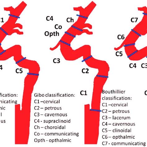 (PDF) Carotid-ophthalmic aneurysms—Our results and treatment strategy