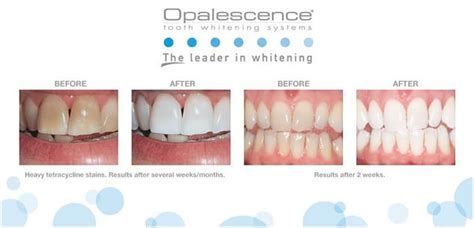 Teeth Whitening – Glenhuntly Dental Clinic