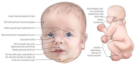 beckwith-wiedemann syndrome life expectancy - Google Search | Noonan syndrome, Turner syndrome ...