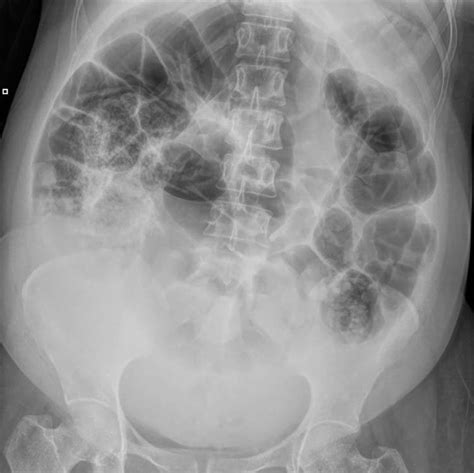 X-ray Abdomen, 24 h after commencement of symptoms. Widespread... | Download Scientific Diagram