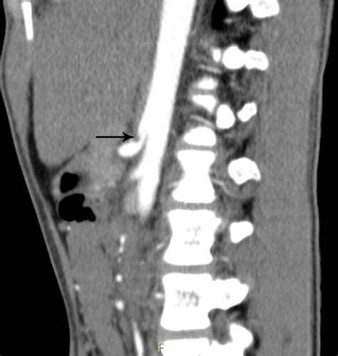 Imaging in median arcuate ligament syndrome | BMJ Case Reports