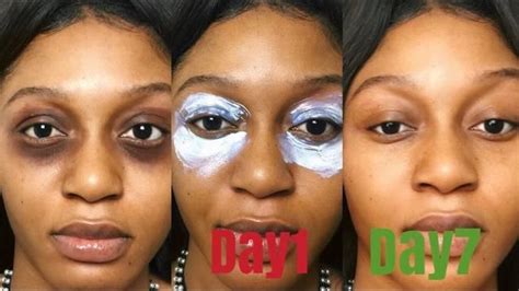 How to Get Rid of Dark Circle Under Eyes/or Dark Spots Fast | Dark spots under eyes, Dark eye ...