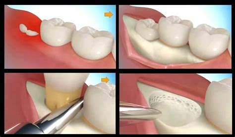 All you need to know about Wisdom tooth surgery and how much it costs! – Cluny Court Family ...