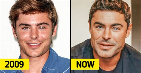 “I Almost Died,” Zac Efron Explains What Really Happened to His Face ...