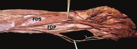 Fds And Fdp Tendons Test / Secondary Procedures for Failed Tendon Transfers ... - The ...