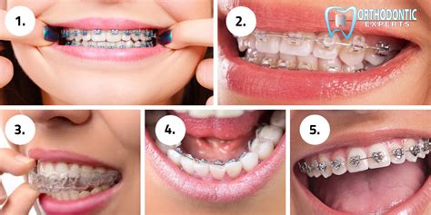 Different Types Of Braces: What Are They? | Top Orthodontist: Braces ...