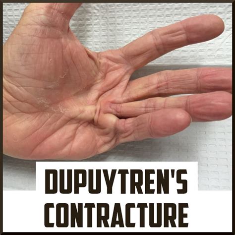 Review on Dupuytren's Contracture - Sports Medicine Review