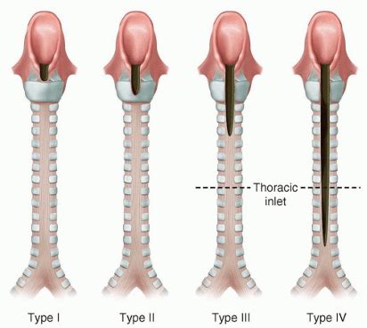 Diagram showing the types of laryngeal cleft. Reproduced with... | Download Scientific Diagram